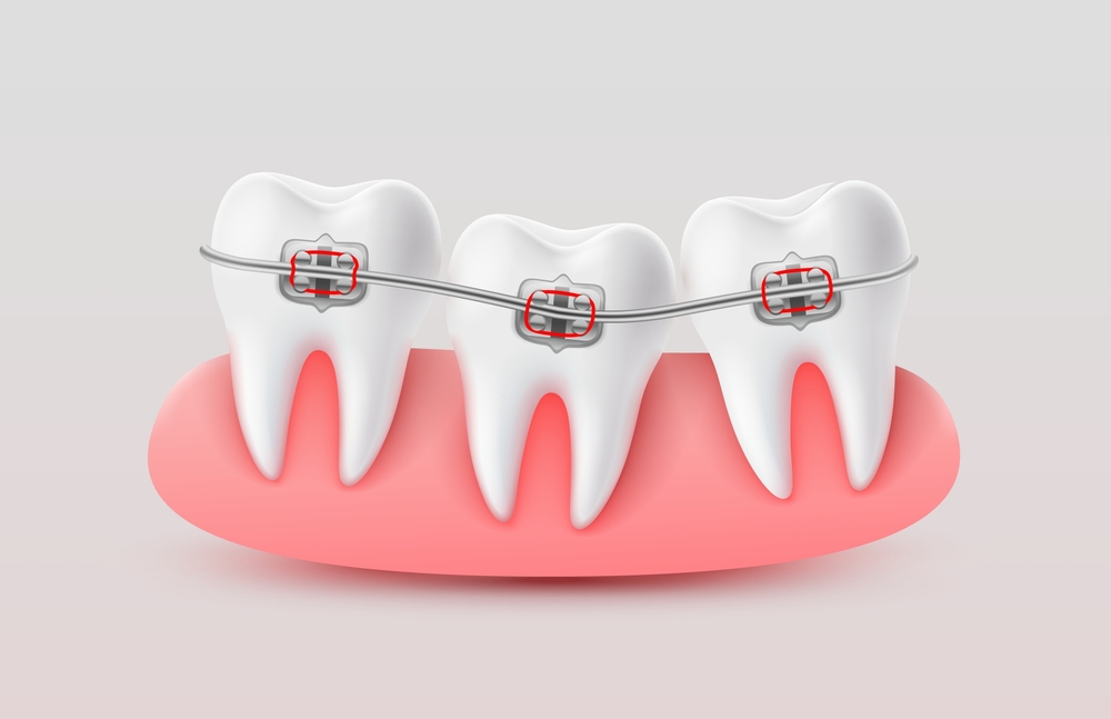 the different types of braces explained which one is right for you