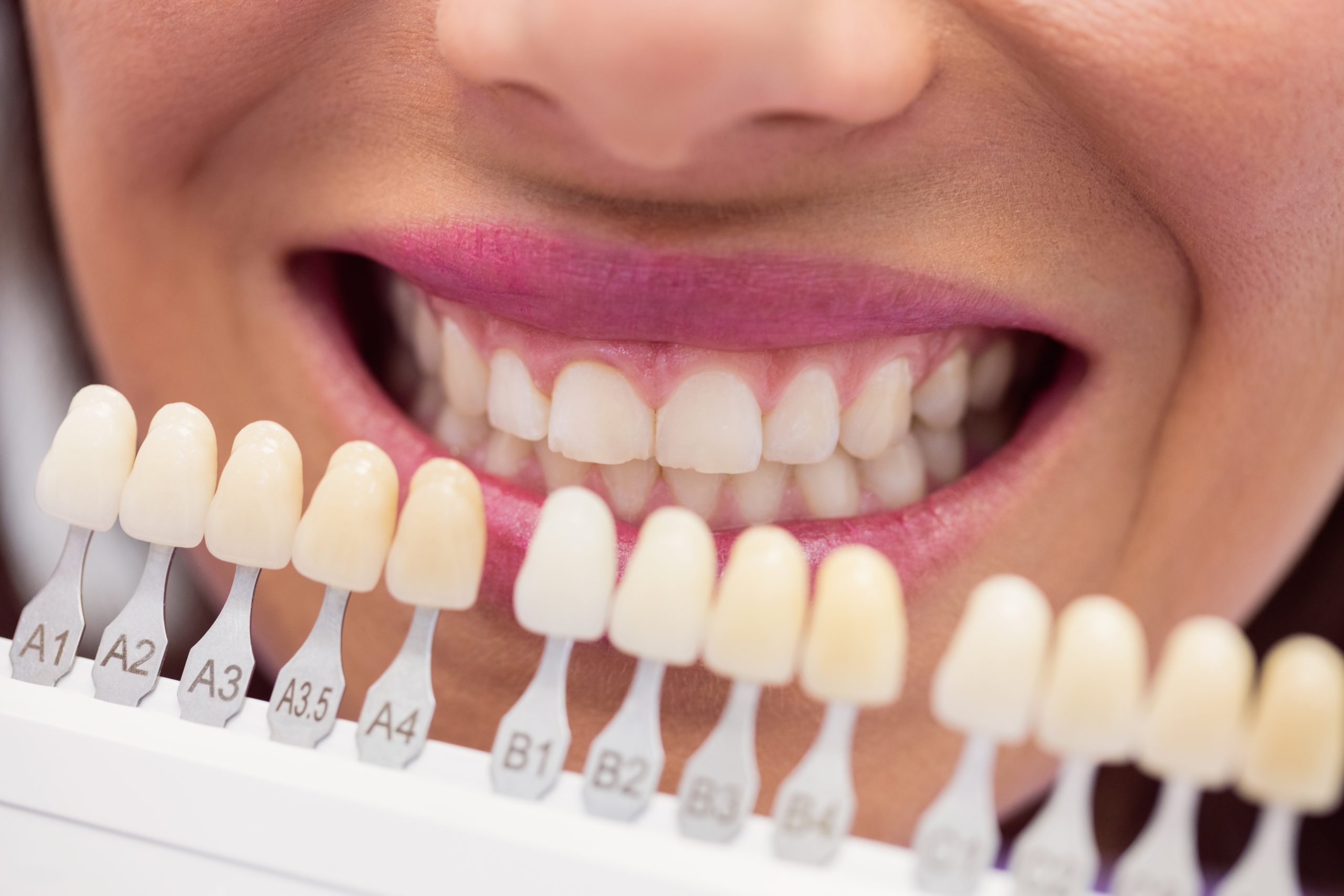 What Do Teeth Look Like Before And After Getting Veneers?