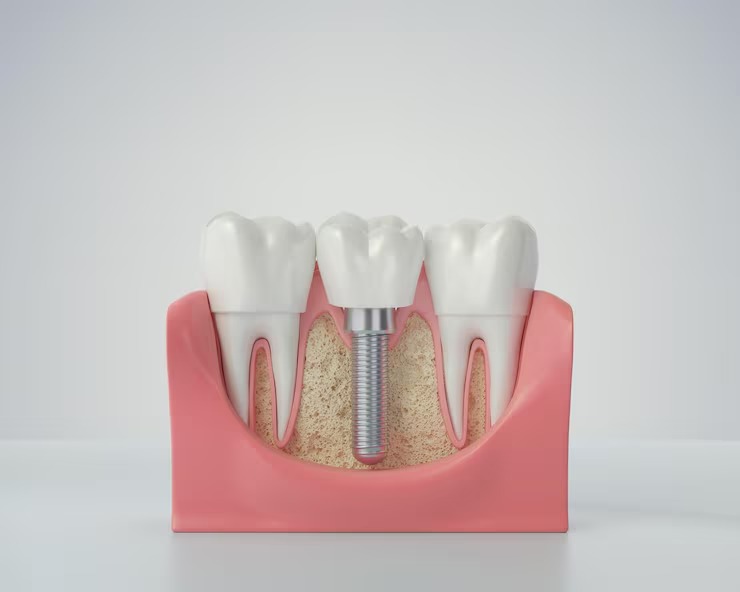 Tooth implant illustration showing titanium screw base