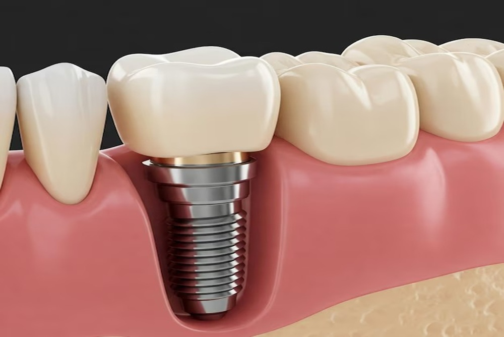 Dental Implants