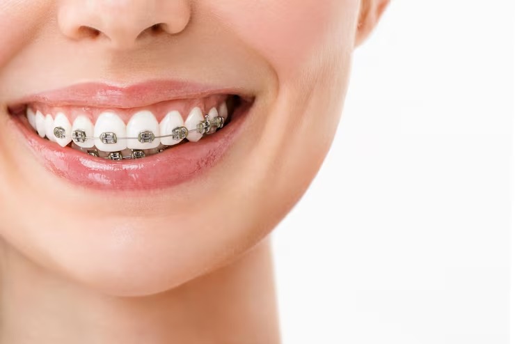 The hidden benefits of braces most patients don't know