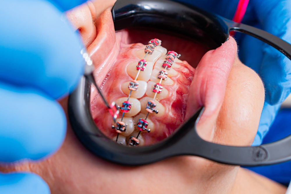 Orthodontic treatment